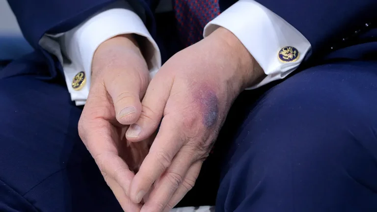 trump-bruise-hand